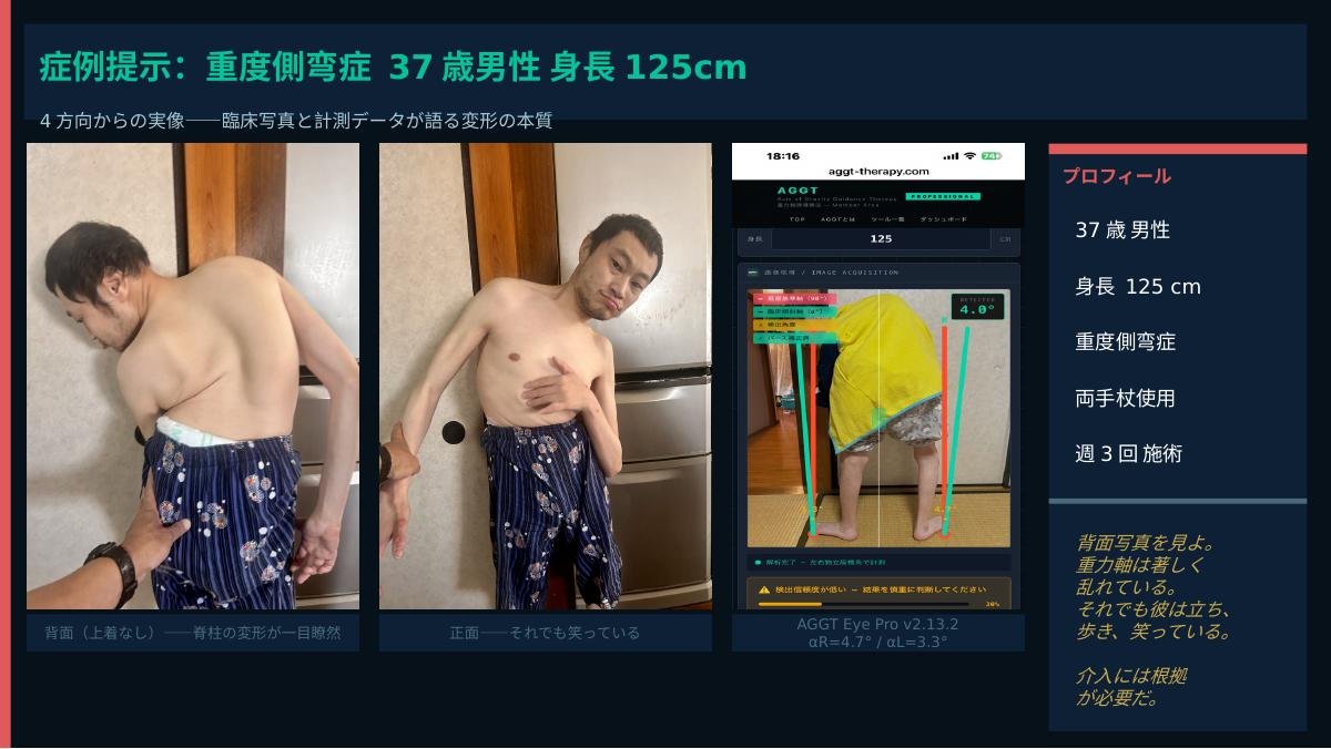症例提示:重度側弯症 37歳男性 身長125cm